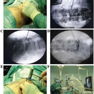 Percutaneous Endoscopic Lumbar Discectomy Procedures A Percutaneous