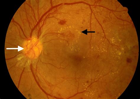 Active neovascularization in PDR a - Endotext