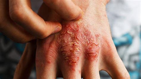 Dermatitis Atópica Severa ~ Psoriasis