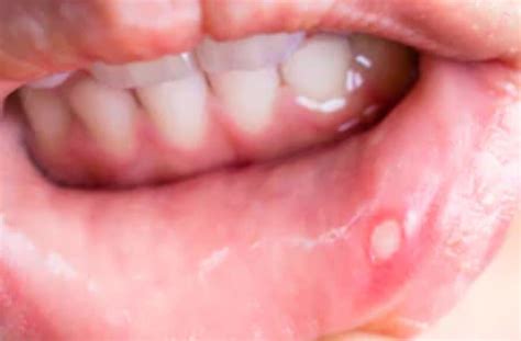 Staph Infection On Lips