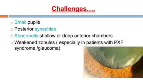 Indication Of Combined Cataract And Glaucoma Surgery Pptx