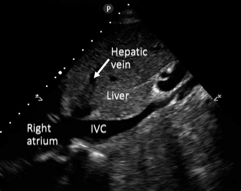 Point Of Care Echocardiography Subxiphoid Long Axis