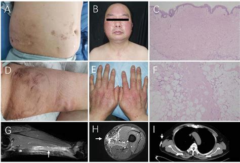 Figure 1 From Pyomyositis Secondary To Localized Cellulitis In A