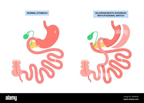 Biliopancreatic diversion (BPD) with duodenal switch, illustration. BPD ...