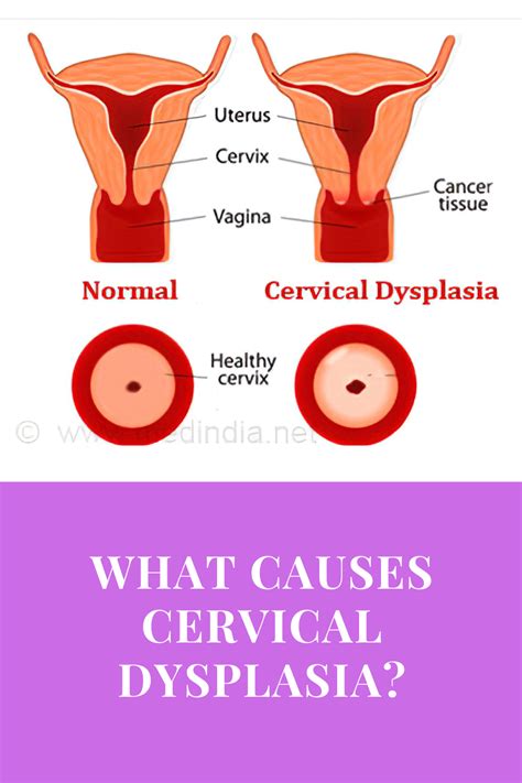 What Causes Cervical Dysplasia Artofit