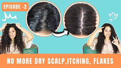 Dry Itchy Flaky Scalp Routine And Products Scalp Care Series Ep2 Thrive Co Scalp Care Youtube