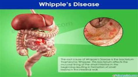 Whipples Disease Youtube