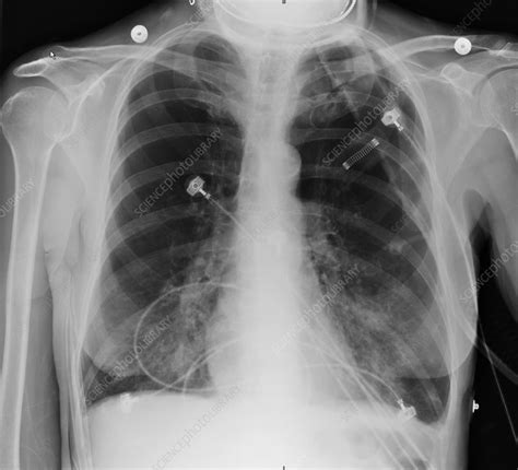 Chest X Ray Copd