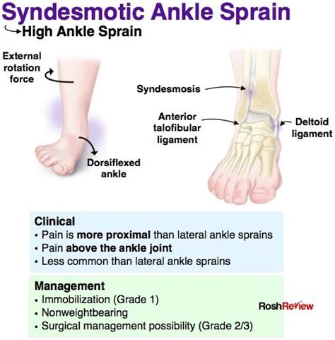 Syndesmotic Ankle Sprain | Medical knowledge, Human anatomy and physiology, Orthopedic nursing