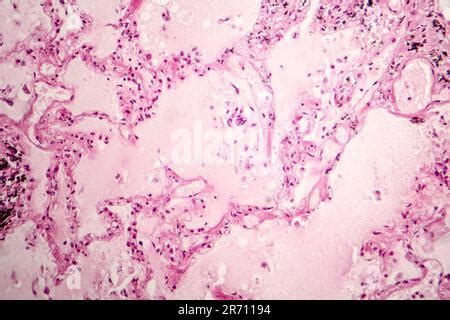 Histopathologie de l œdème pulmonaire aigu micrographe léger montrant