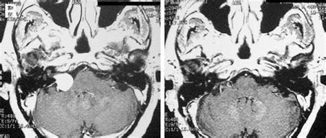 Figure 1 From Contralateral Hearing Disturbance Following Posterior Fossa Surgery —case Report