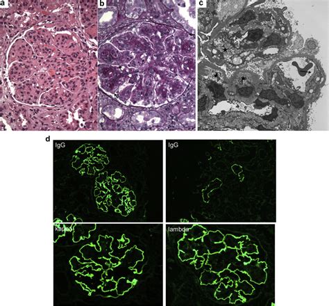 Anti Glomerular Basement Membrane Glomerulonephritis A Morphologic