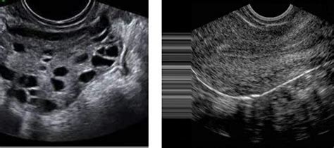 Overview Of Dataset A Left Image Is A Polycystic Ovarian Ultrasound Download Scientific