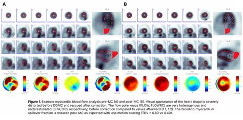 Evaluation Of Data Driven Motion Correction Algorithm For Myocardial