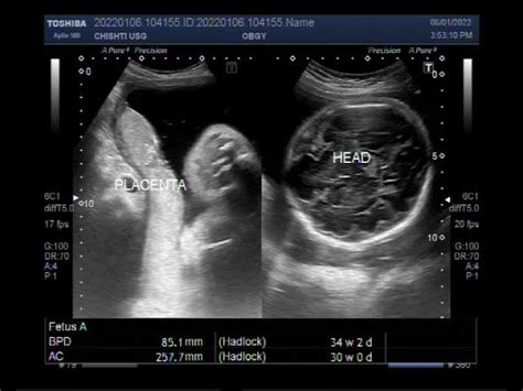 Spina Bifida Ultrasound 13 Weeks