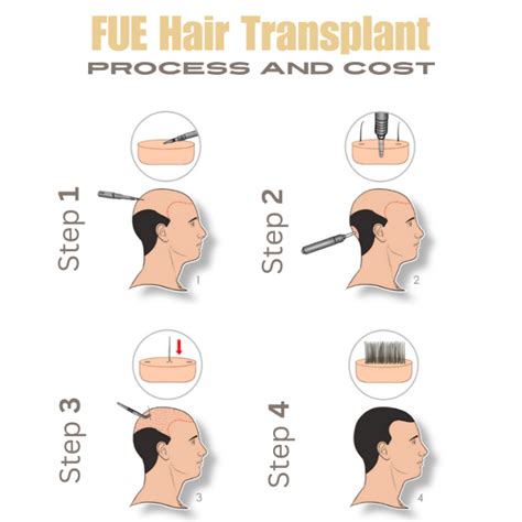 Fue Hair Transplant In Turkey Cost In 2025 Vantage