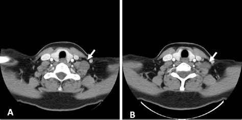 Contrast Enhanced Computed Tomography Ct Scan Axial View Showing