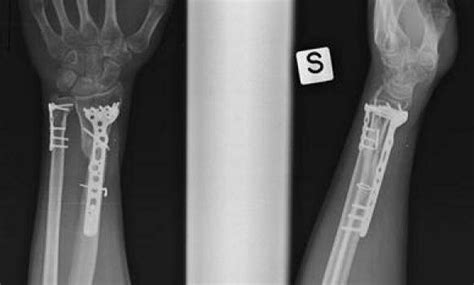 X Rays At 6 Months Of An A3 Fracture Plate Fixation Acu Lock