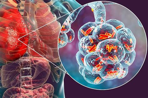 Legionella E Legionellosi Sintomi Diagnosi E Terapia Emergency Live