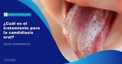 Cuál es el tratamiento para la candidiasis oral Zonadental