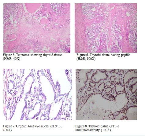 Papillary Thyroid Carcinoma Arising Within Mature Ovarian Teratoma A