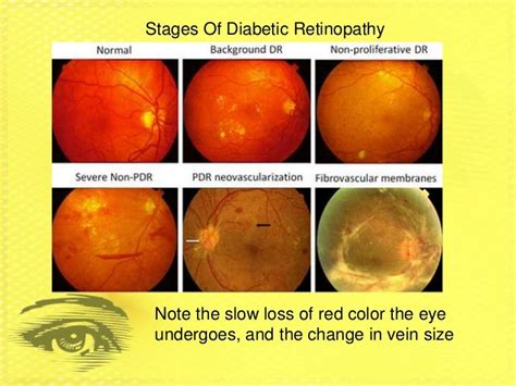 Diabetic Retinopathy Group 7 Period 2 New 4