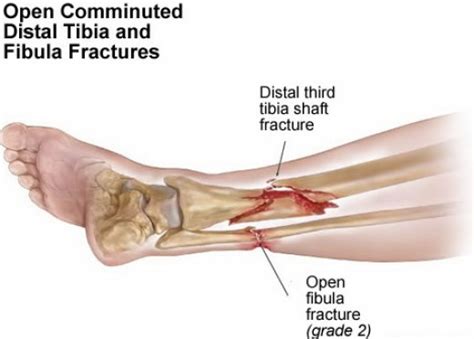 GENERAL SIGNS AND SYMPTOMS OF FRACTURE | hubpages