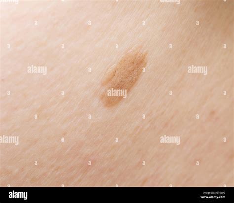 Birthmark Stock Photos And Birthmark Stock Images Alamy