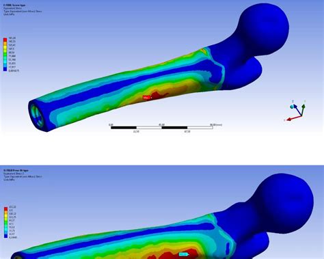 Figure 11 From Biomechanical Analysis Of Two Types Of Osseointegrated