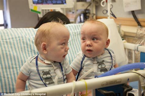 Conjoined Twins Separated In Dallas Are Released From Hospital Daily Mail Online