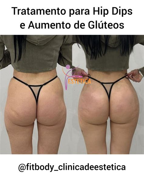 Tratamento Para Hip Dips E Aumento De Gl Teos Cl Nica Fit Body Est Tica