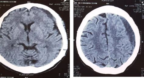 Acute Vs Chronic Subdural Hematoma