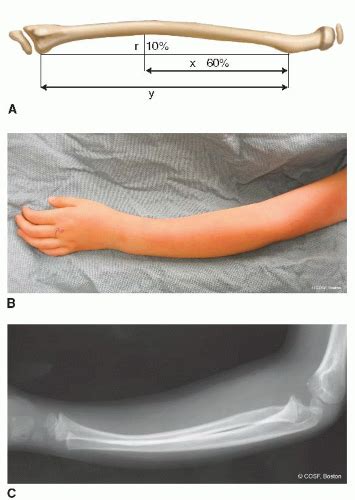 Forearm Fractures Musculoskeletal Key