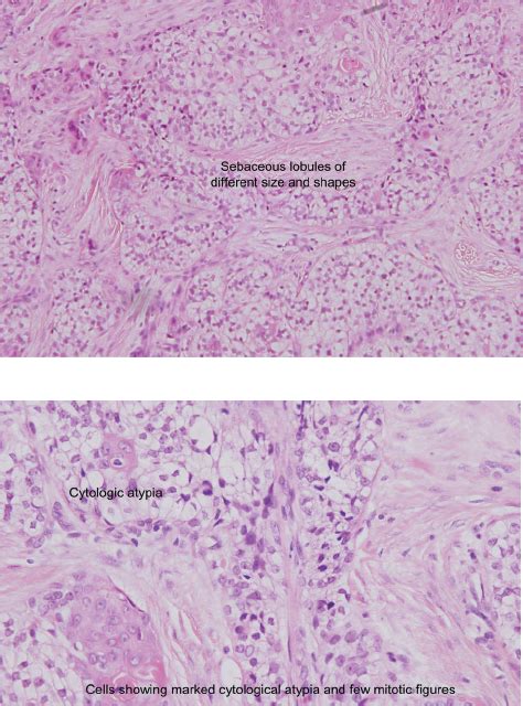 A B A Low Power B High Power The Biopsy Specimen Showed Marked