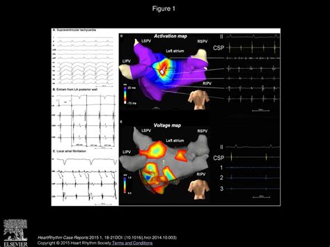 Focal Atrial Fibrillation Presenting In The Origin Of Atrial