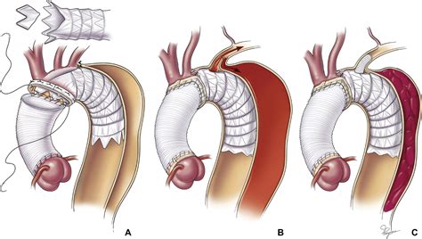 Evolution Of Simplified Frozen Elephant Trunk Repair For Acute Debakey