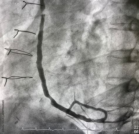 coronary angiogram showed saphenous vein graft (SVG) was stenosis after ...