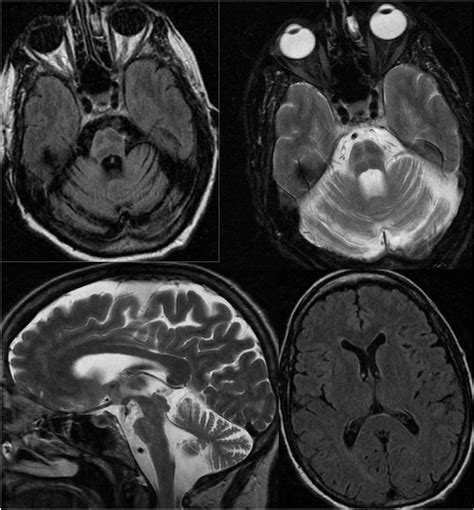 Multisystem Atrophy