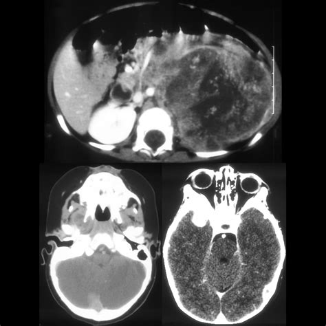 Neuroblastoma Pediatric Radiology Reference Article Pediatric