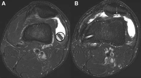 Trochlear Dysplasia As Shown By Increased Sulcus Angle Is Associated With Osteochondral Damage