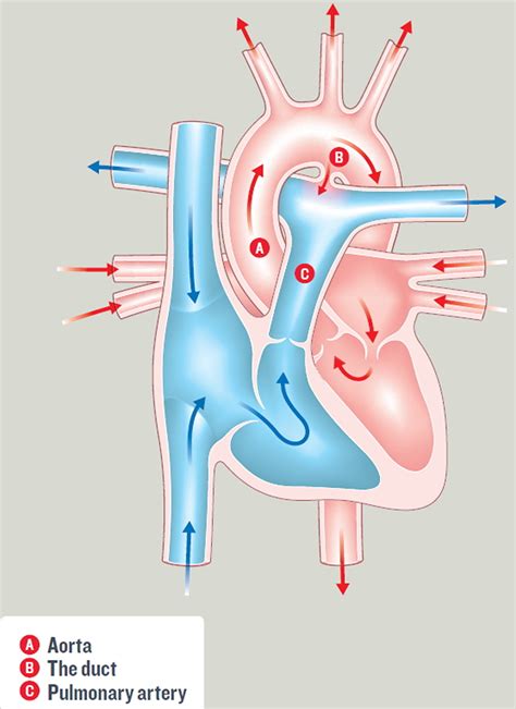 Patent Ductus Arteriosus Causes Symptoms Diagnosis Treatment