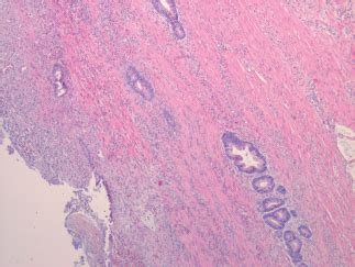 H E Section Demonstrating Adenocarcinoma Infiltrating The Muscular