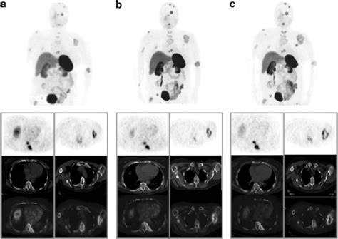 68 Ga DOTATOC PET CT In A Metastatic Insular TC At Baseline A And