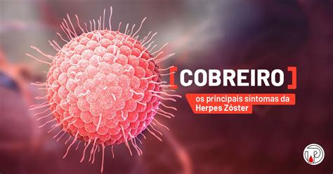 Tudo Sobre O Termo Herpes Zoster