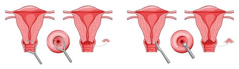 Infographic On Cervical Dysplasia Invasive Carcinoma And Uterine Cancer