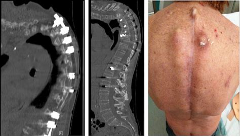 A Case Of Deep Infection After Instrumentation In Dorsal Spinal Surgery