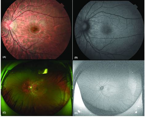 Fundus Photography And Ultrawide Field Fundus Photography Of One Of The