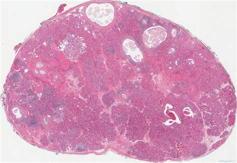 Sclerosing Polycystic Adenoma Of The Salivary Gland Ottawa Atlas Of