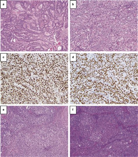 SWI SNF Intact Dedifferentiated Endometrial Carcinoma And FIGO The