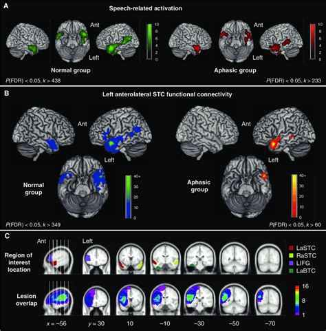 Functional Imaging Data In The Normal And Aphasic Groups A